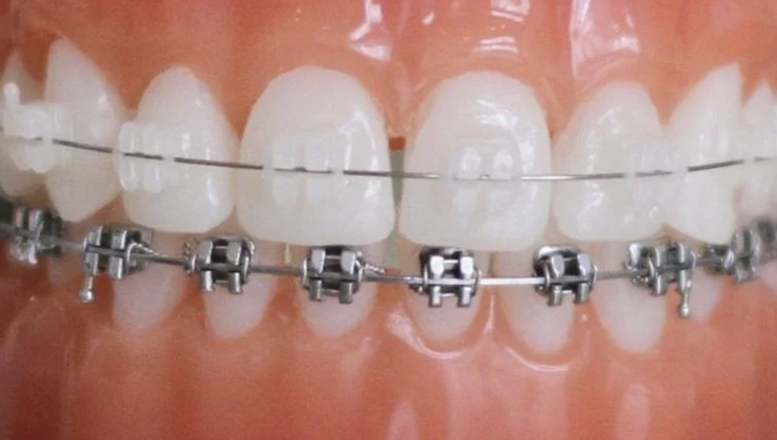 Keramikbrackets