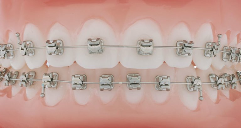 Mini-Metallbrackets