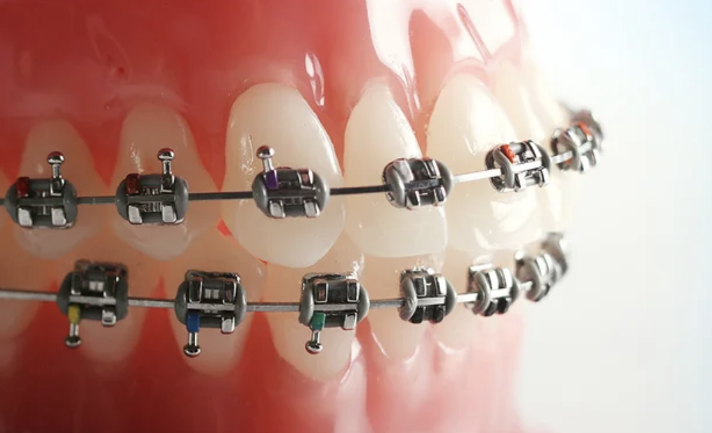 Mini-Metallbrackets